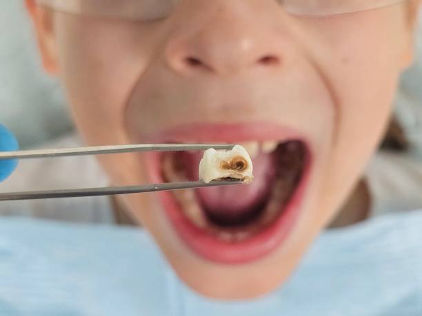 Best Emergency Broken Tooth Repair in Bellevue, WI